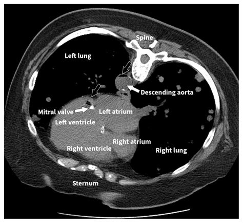 Aortic And Cardiac Air Emboli In An Older Woman Cmaj