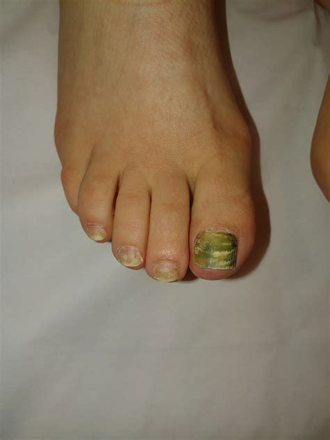 Green Nail Pseudomonas Infection Fungal Laser Nail Surgery Specialist Clinic In London