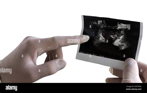 Ultrasound Of Male Prostate Isolated On White Background Close Up