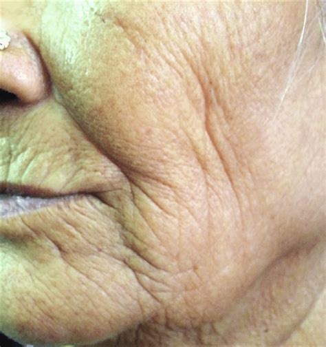 Intrinsic Aging Sagging And Lax Skin With Deep Wrinkles In A