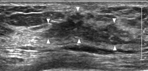 Nonmasslike Lesions On Breast Sonography Kim 2014 Journal Of