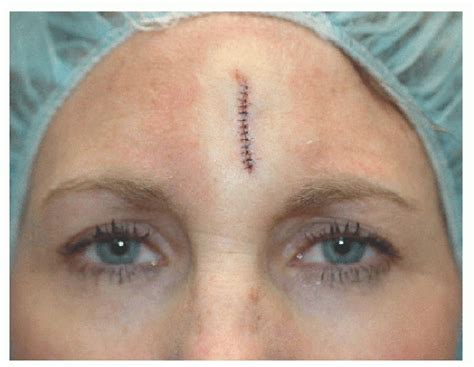 Forehead And Temple Reconstruction Plastic Surgery Key