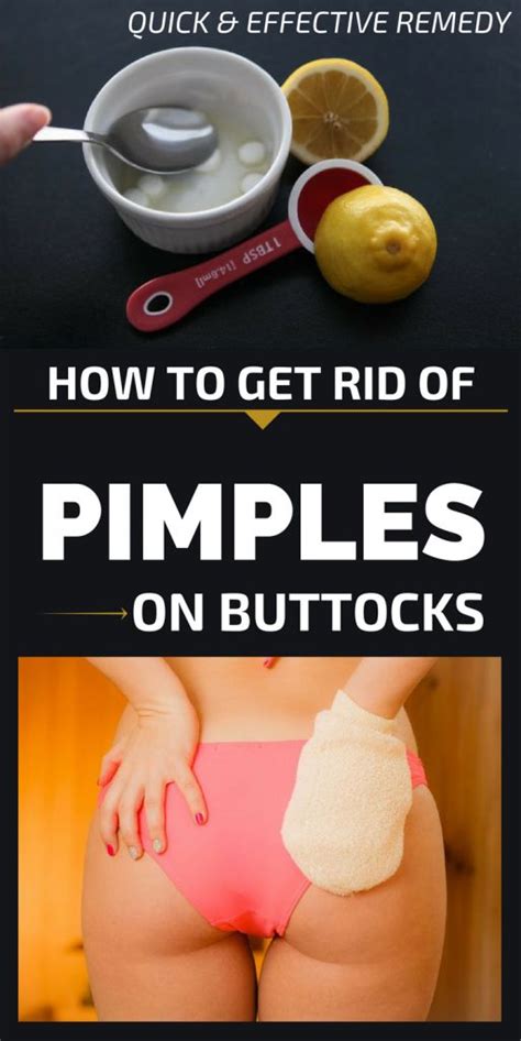 how to get rid of pimples on buttocks pimples on buttocks how to get rid of pimples pimples