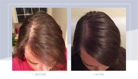 Dry Thinning Hair Hypothyroidism Half Weave Install On Thinning Hair