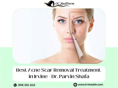 Acne Scar Removal Treatments In Orange County Dr Parvin Shafa By Oc