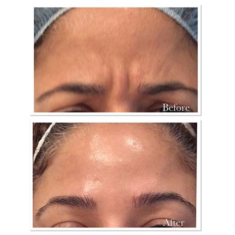 Before And After Cosmetic Treatment Gallery Parfaire Medical Aesthetics