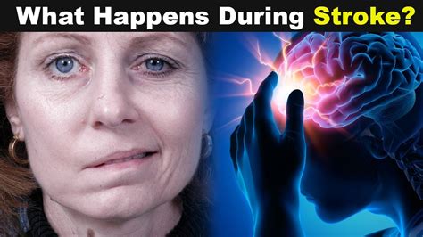 What Happens During A Stroke Stroke Causes Symptoms And Treatments