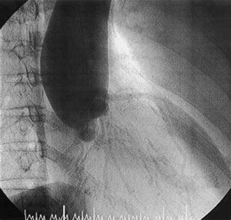 Aortic Root Angiography Shows Grade 2 Regurgitation Bicuspid Aortic