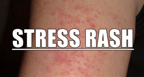 What Causes Stress Rash On The Face How To Treat It