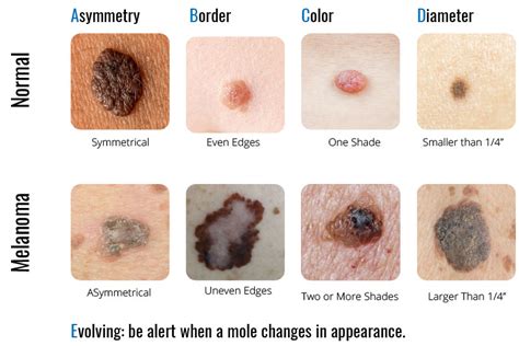 Skin Cancer Dermatology And Plastic Surgery In Palm Desert Ca