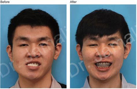 Patient 4 Orthognathic Surgery Photo Gallery Dr Majid Jamali