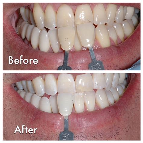 Laser Teeth Whitening In North Scottsdale Az Laser Dentistry