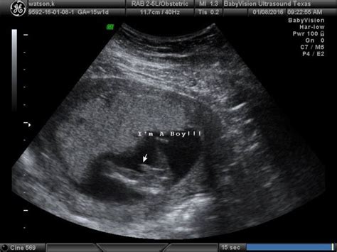 13 15 Week Gender Ultrasounds Page 7 Babycenter