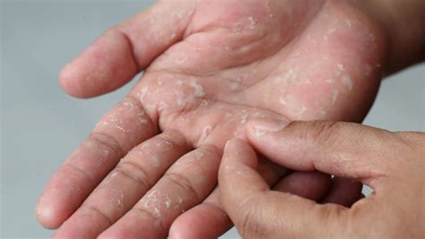 Bolhas Nos Pés E Nas Mãos Pode Ser Disidrose Conheça Problema