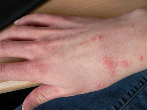 Disease Outbreak Control Division Scabies