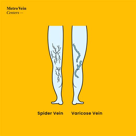 Are Varicose Veins Dangerous Metro Vein Centers