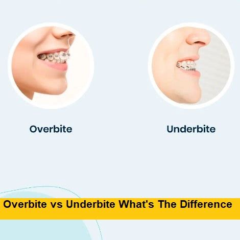 Overbite Vs Underbite What S The Difference Getprosonic