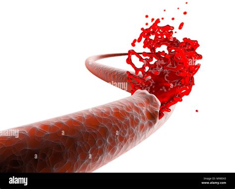 Vein Artery Rupture Cut Blood Hemorrhage Internal Bleeding Cut Of A