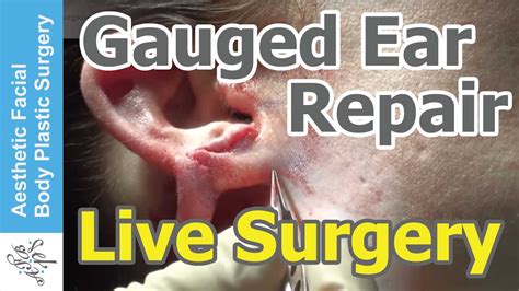 Warning Graphic Gauged Earlobe Repair Live Surgery Otoplasty By