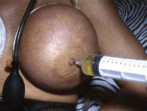 Saline Injections Bdsm Tit Torture