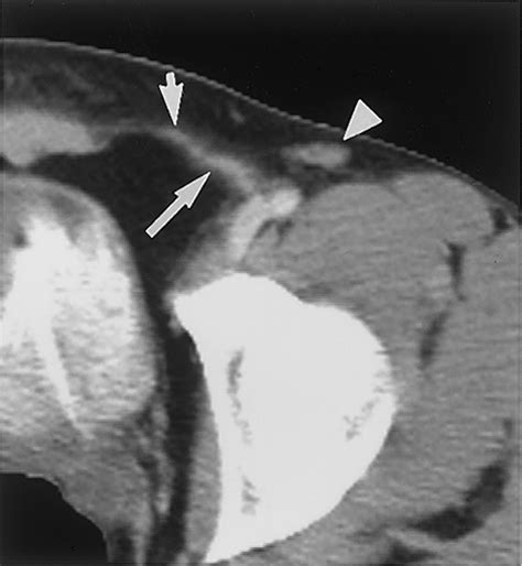 Imaging Of Groin Masses Inguinal Anatomy And Pathologic Conditions