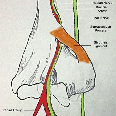 The Schematic Drawing Of Median Nerve Between The Struthers Ligament