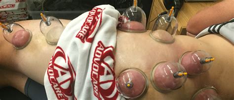 Cupping therapists place cups onto different parts of the body (the back and shoulders are especially common). Still wondering what "cupping therapy" entails? You're ...