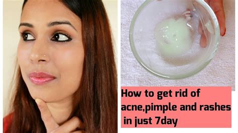 How To Get Rid Of Acne Pimple And Rashes In Just 7 Days100 Natural