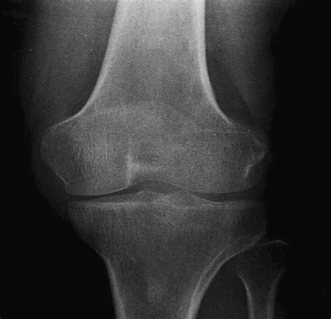 Is This A Normal Knee X Ray American Journal Of Physical Medicine