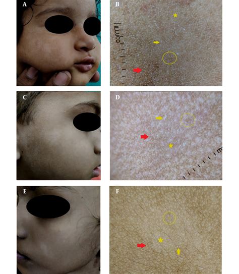 Facial Pityriasis Alba Polymorphous Light Eruption And Vitiligo In