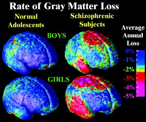 Mapping Adolescent Brain Change Reveals Dynamic Wave Of Accelerated