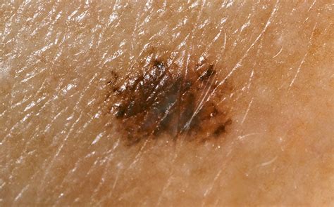 Melanoma In Situ And Mortality Is There Cause For Concern Hospital