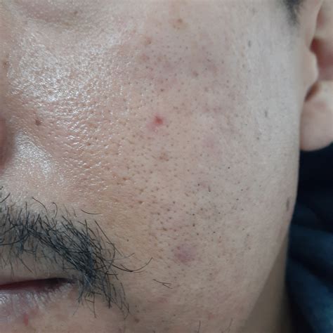 Help Severe Acne Scars Scar Treatments