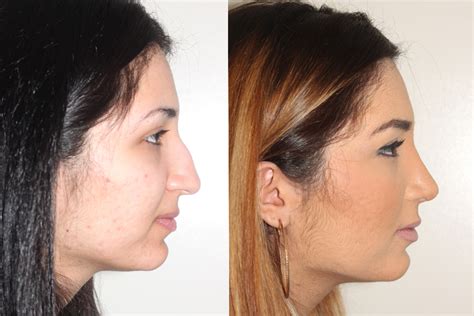 This outward curvature of the upper back and compression of the front sections of the vertebrae cause a person to lean forward, slouching their. Case Study - Open Rhinoplasty Surgery in Vancouver