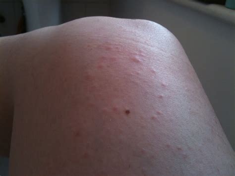 White Patch Of Skin On Knee Todaymuse2gover