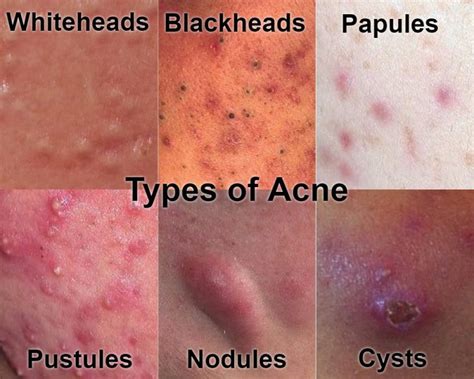 Depressed scars are the most common type of scar that results from inflammatory acne. Here is Everything You Need to Know about Curing Acne and ...