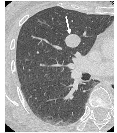 Chest Computed Tomography Ct Scan Obtained 5 Years After The First