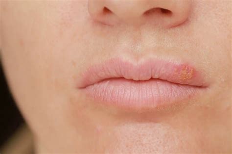 Mix · Lip Dermatitis 7 Natural Home Remedies For Lips Eczema