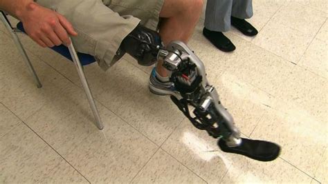 Often, a person's legs go numb temporarily because of their posture. World's First Bionic, Mind-Controlled Leg Allows Amputee ...