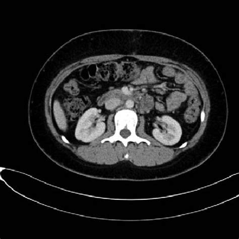 The Postoperational 18f Fdg Petct Presented 2 Enlarged Para Aortic