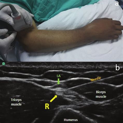 A Placement Of The Ultrasound Probe In The Supracondylar Radial Nerve