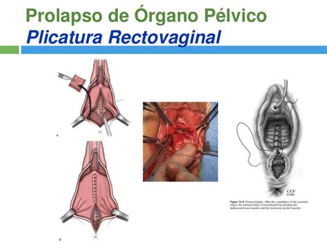 Cirugia Reconstructiva Del Prolapso De Organo Pelvico