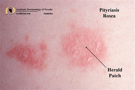 Pityriasis Rosea Diagnosis