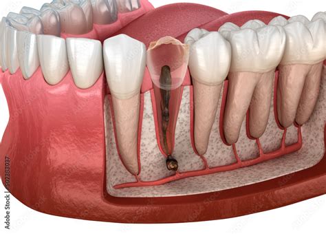 Periostitis Tooth Lump On Gum Above Tooth Dental 3d Illustration