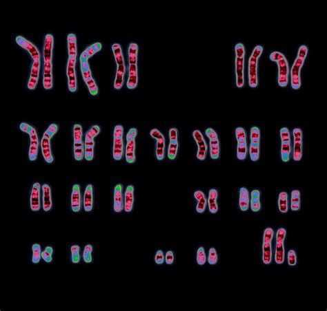 Klinefelters Syndrome Karyotype 47xxy Wellcome Collection