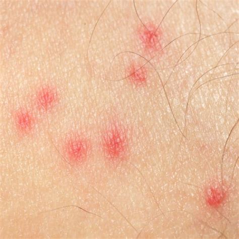 Identify The Cause Of Your Itchy Bug Bite