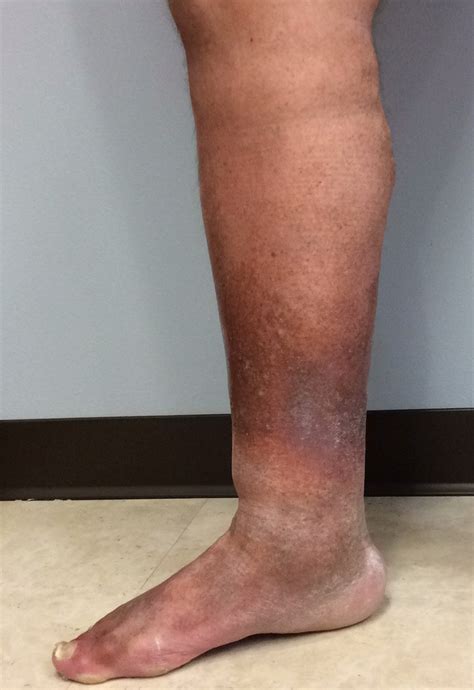 Venous Insufficiency Pictures And Images A Visual Guide