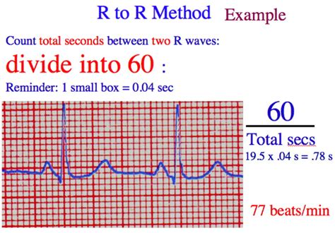 How To Calculate Heart Rate In Ecg Strip Haiper