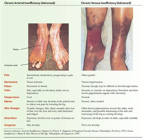 Venous ulceration (see image below) is commonly noted in the gaiter region of the legs. Image result for arterial vs venous insufficiency | Icu ...