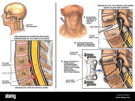 Spine Surgery Cervical Disc Protrusions At C4 5 And C5 6 With Stock